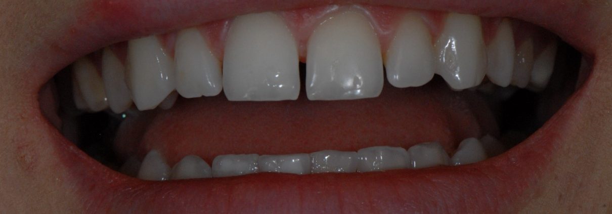 Gaps between my teeth before treatment