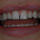 Gaps between my teeth before treatment