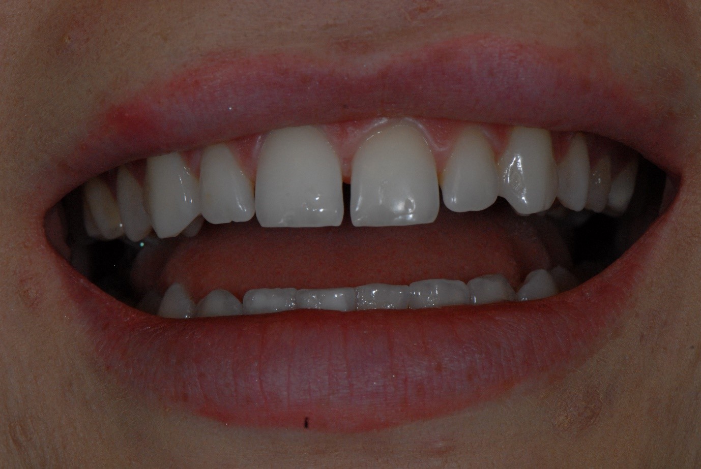 gapped teeth