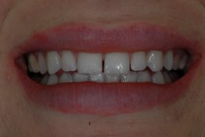 What Can I Do About The Gaps Between My Teeth Dr Martin Jest Dentist